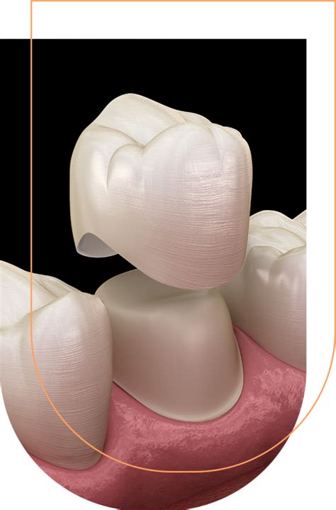 dental crowns arvada|Same Day Crowns by CEREC .